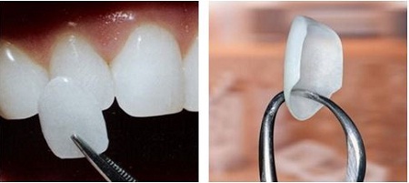 Facet Dental Treatments at Karol`s Dental Clinic