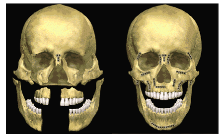 Facial Trauma Symptoms