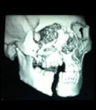 Facial trauma